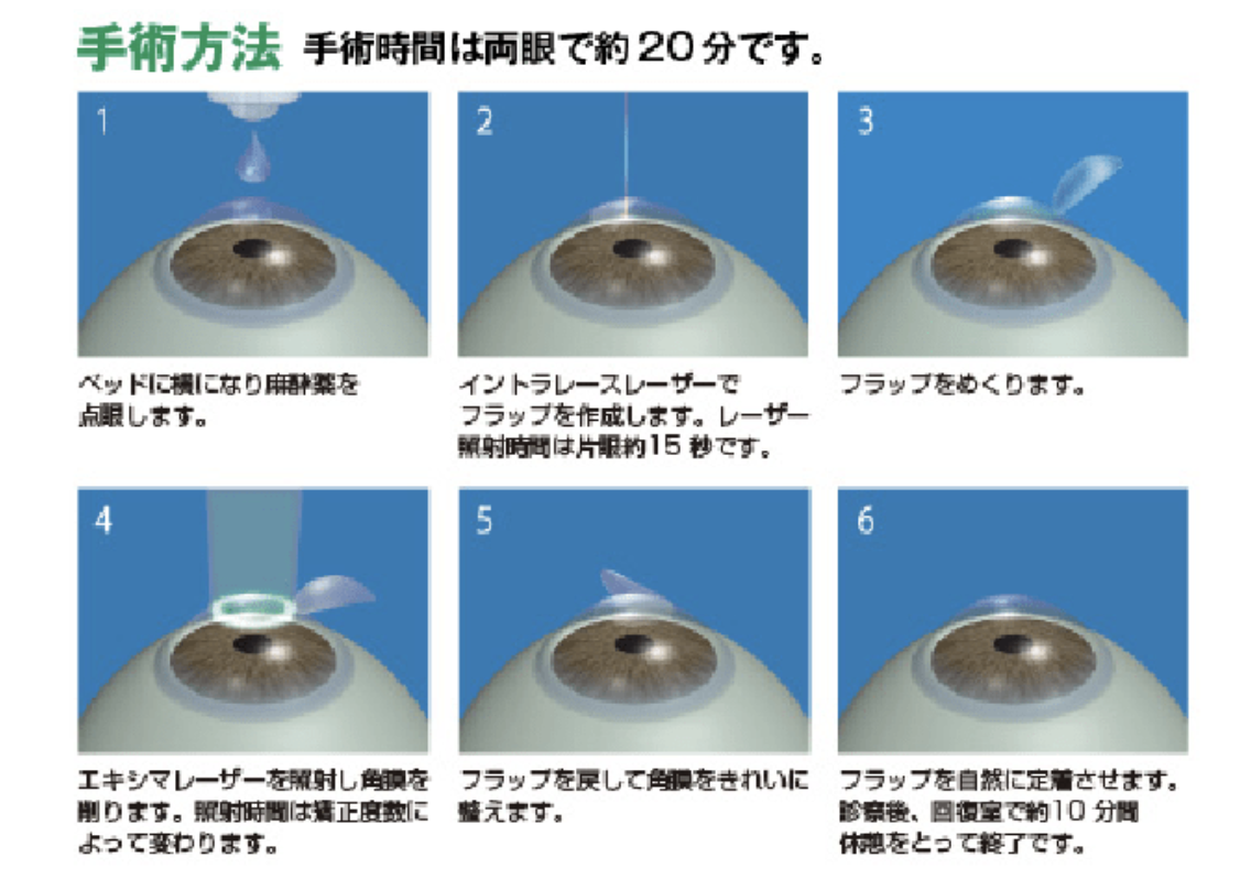 レーシック手術の手順