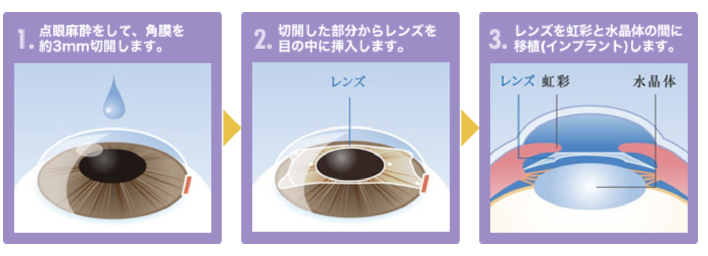 ICL手術についての方法